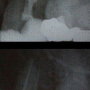 reendodoncia - nájdenie a zaplnenie ďalšieho koreňového kanálika u pacienta s predchádzajúcou nesprávne vyhotovenou koreňovou výplňou