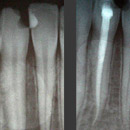 endodontické ošetrenie - zaplnenie koreňového kanálika