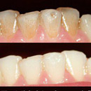 AIRFLOW - opieskovanie zubov, odstránenie povlakov a pigmentov