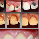 pacient vek 14 rokov zanedbaná starostlivosť a slabá hygiena dutiny ústnej, rozsiahle podbiehavé kazy na predných horných rezákoch, ťažký zápal ďasien. Ďasná sú opuchnuté a na dotyk krvácajú terapia: 1.hygienická inštruktáž čistenia zubov spojená s odstránením zubného kameňa a povlakov 2.vybratie kazových hmôt a odstránenie ďasna nad defektom pomocou kautera, kompozitná dostavba zubov 3.dolná fotografia - kontrola po 6 mesiacoch, pacient si osvojil hygienické návyky, zápal ďasien zmizol, ďasná sú zdravé a nekrvácajú