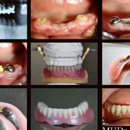 Komplikovaný stav - dolné zuby - vysoká kývavosť a ťažký zápal. Po konzultácii doporučená extrakcia 8 dolných zubov, dolné 3-ky ponechané, dekapitovane a umŕtvené.