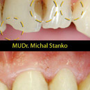 počiatočný stav: medzizubné kazy medzi 22 a 23, odštiepený rožtek zuba 21, staré zapigmentované výplne (Evicrol) medzi 21 a 22  - ošetrenie pomocou kompozitu